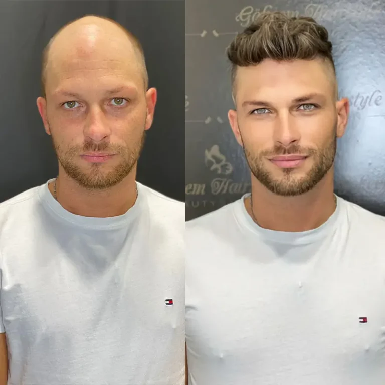 Hair patch for bald area